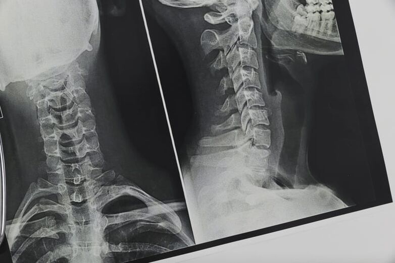 X-ray sa cervical spine nga apektado sa osteochondrosis