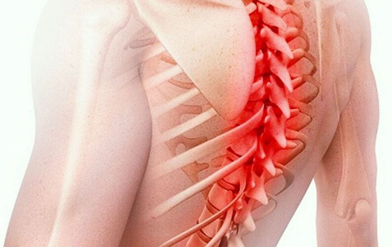 osteochondrosis sa thoracic spine