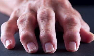 Unsa ang kalainan tali sa arthritis gikan sa arthrosis