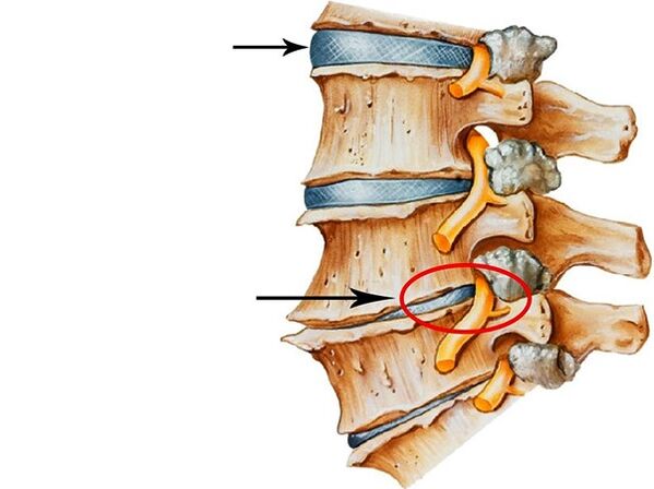 Mga sakit sa mga Intervertebral Dcls