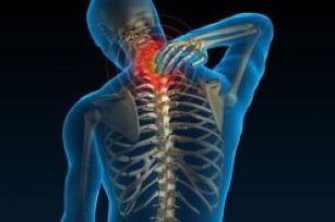 Ang Cervical Osteochondrosis nagdala sa sakit sa liog