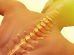 Osteochondrosis - Sakit sa Spine