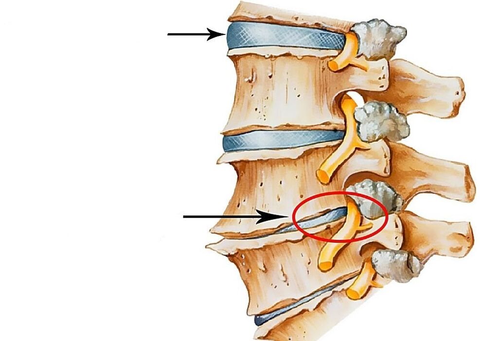 ilustrasyon sa himsog ug deformed spinal discs