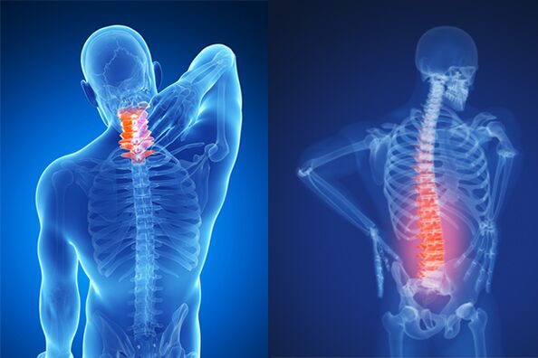 Osteochondrosis sa cervical ug lumbar spine