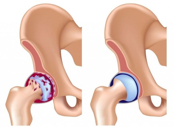 Kadaot sa hip joint tungod sa arthrosis