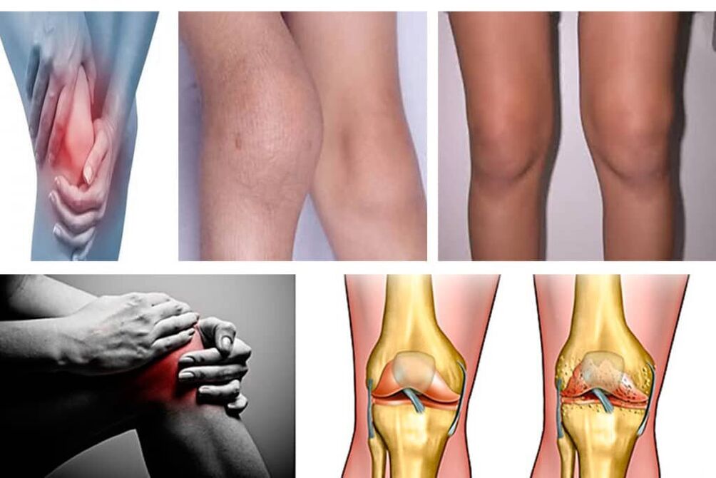 arthrosis unsa kini