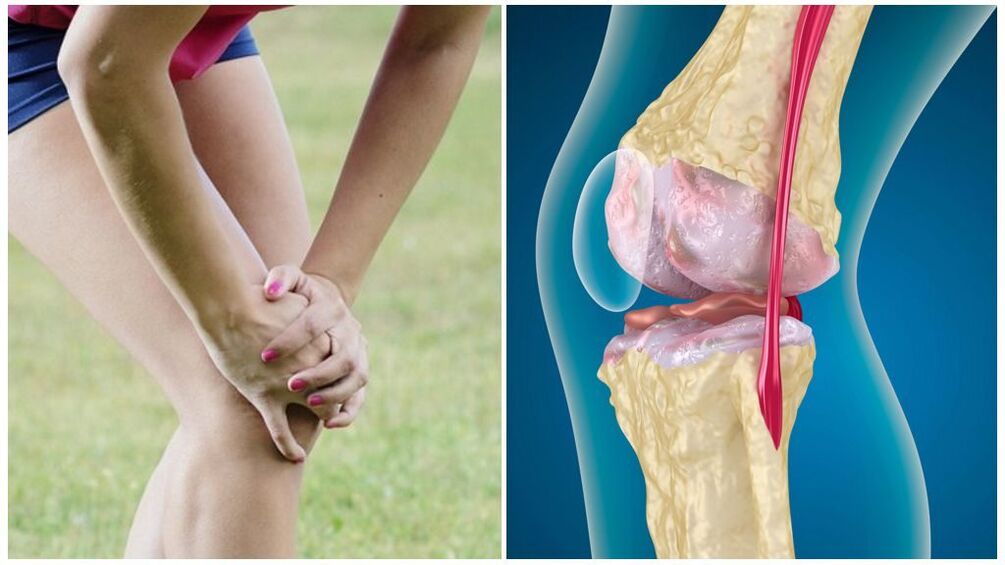 sintomas sa arthrosis