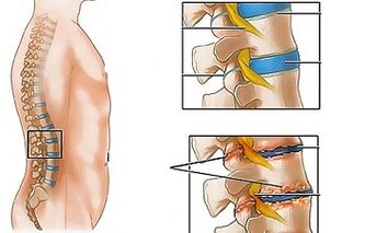 Ang mga hinungdan sa osteochondrosis sa lumbar