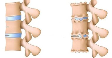 Giunsa ang pag-ila sa presensya sa osteochondrosis sa lumbar